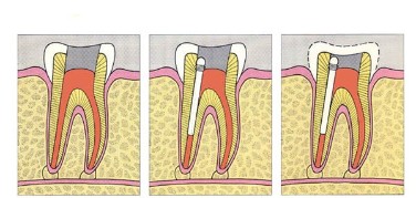 Endodontie - Ihre Zahnarztpraxis Eisel in Rodgau